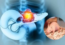 Científicos españoles logran eliminar el cáncer de páncreas más agresivo en pruebas con ratones