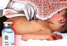 Muere bebé en Tlaxcala por sarampión