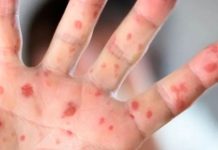 VIDEO / Reportan 41 casos de sarampión en Veracruz