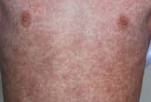 Confirma Salud federal dos casos de sarampión en el estado de Veracruz