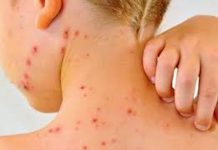 Sarampión se expande por todo México; piden vacunarse