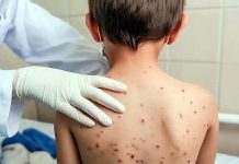 Confirma Nahle 13 de casos de sarampión en el estado de Veracruz