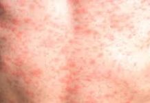 El estado de Veracruz cierra enero con 6 casos confirmados de sarampión y casi 100 probables