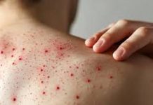 Ya son 25 los casos de sarampión confirmados en el estado de Veracruz