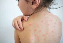 Veracruz acumula 30 casos confirmados de sarampión